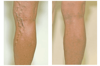 Varicose Veins before & After